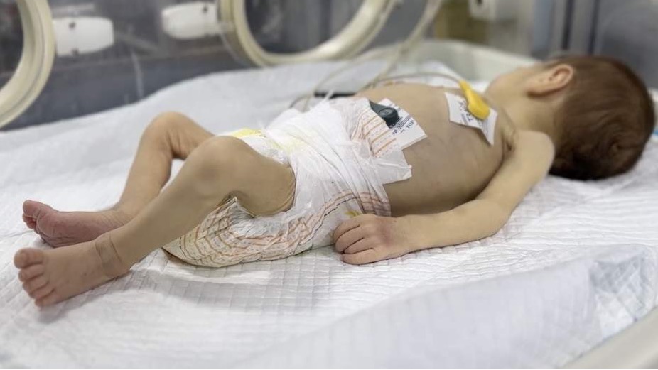 Gaza: Beba Leila životno ugrožena zbog pothranjenosti i nestašice vode